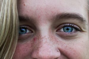 Manuka Honey for Acne