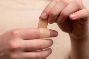 manuka honey for burns